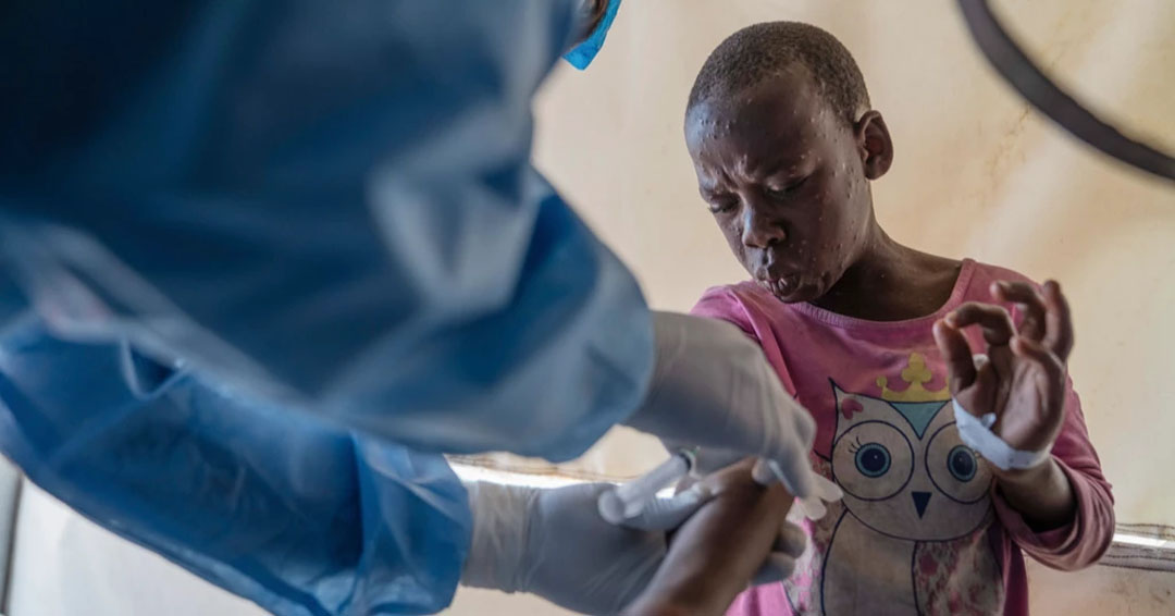 WHO grants first mpox vaccine approval to ramp up response to disease in Africa and beyond